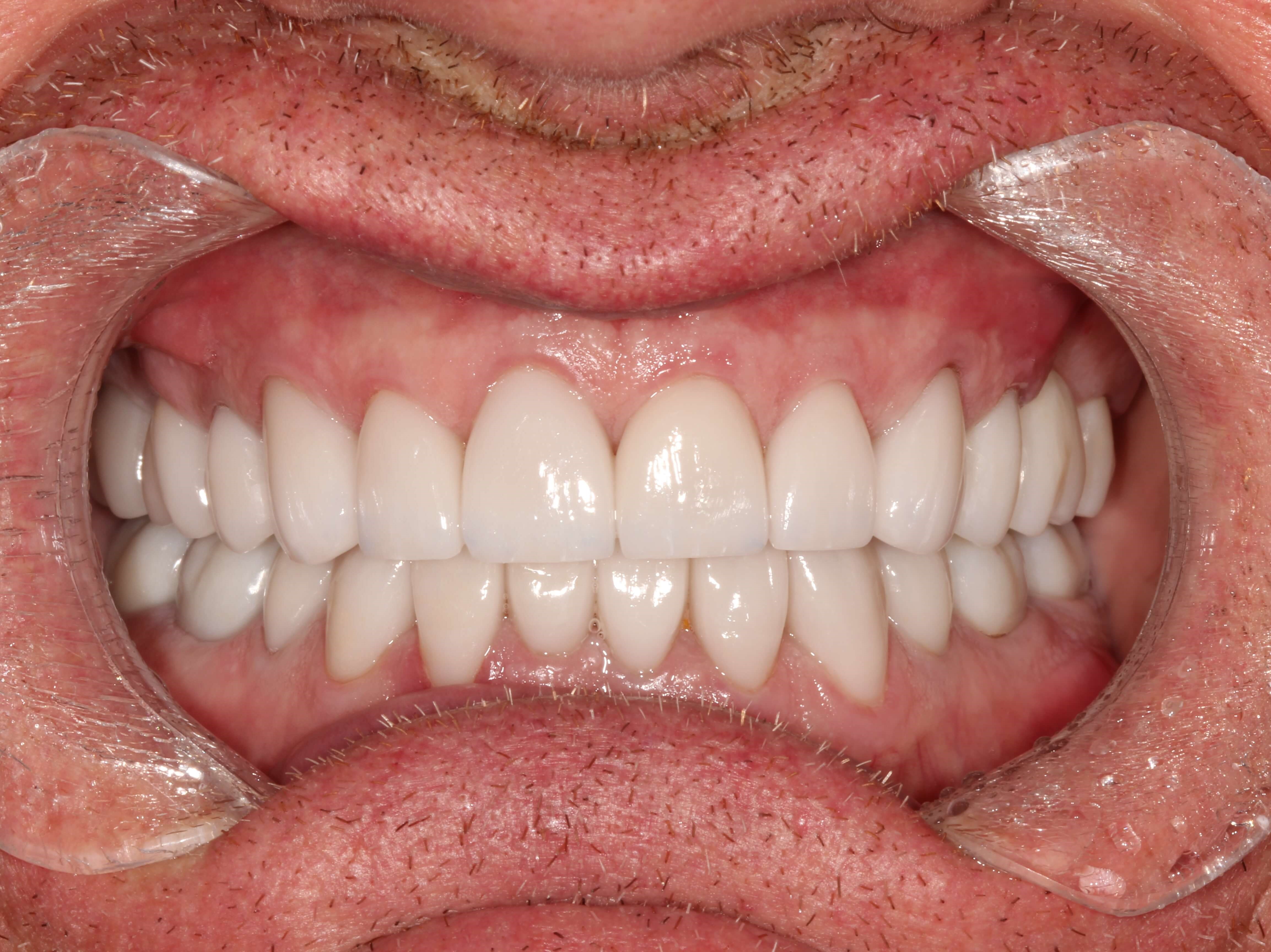 Smile Makeover Before & After After