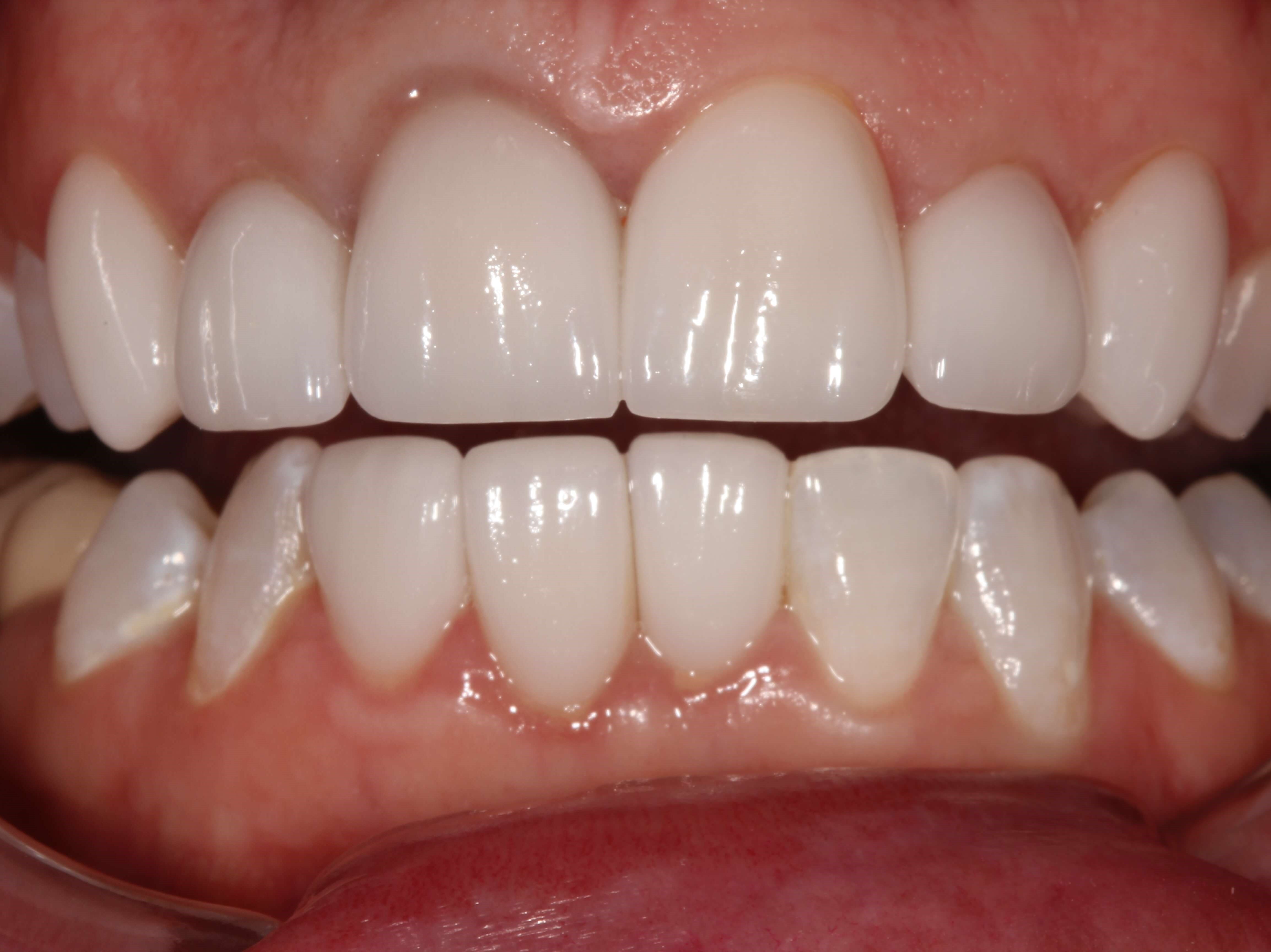 Beautiful Smile After