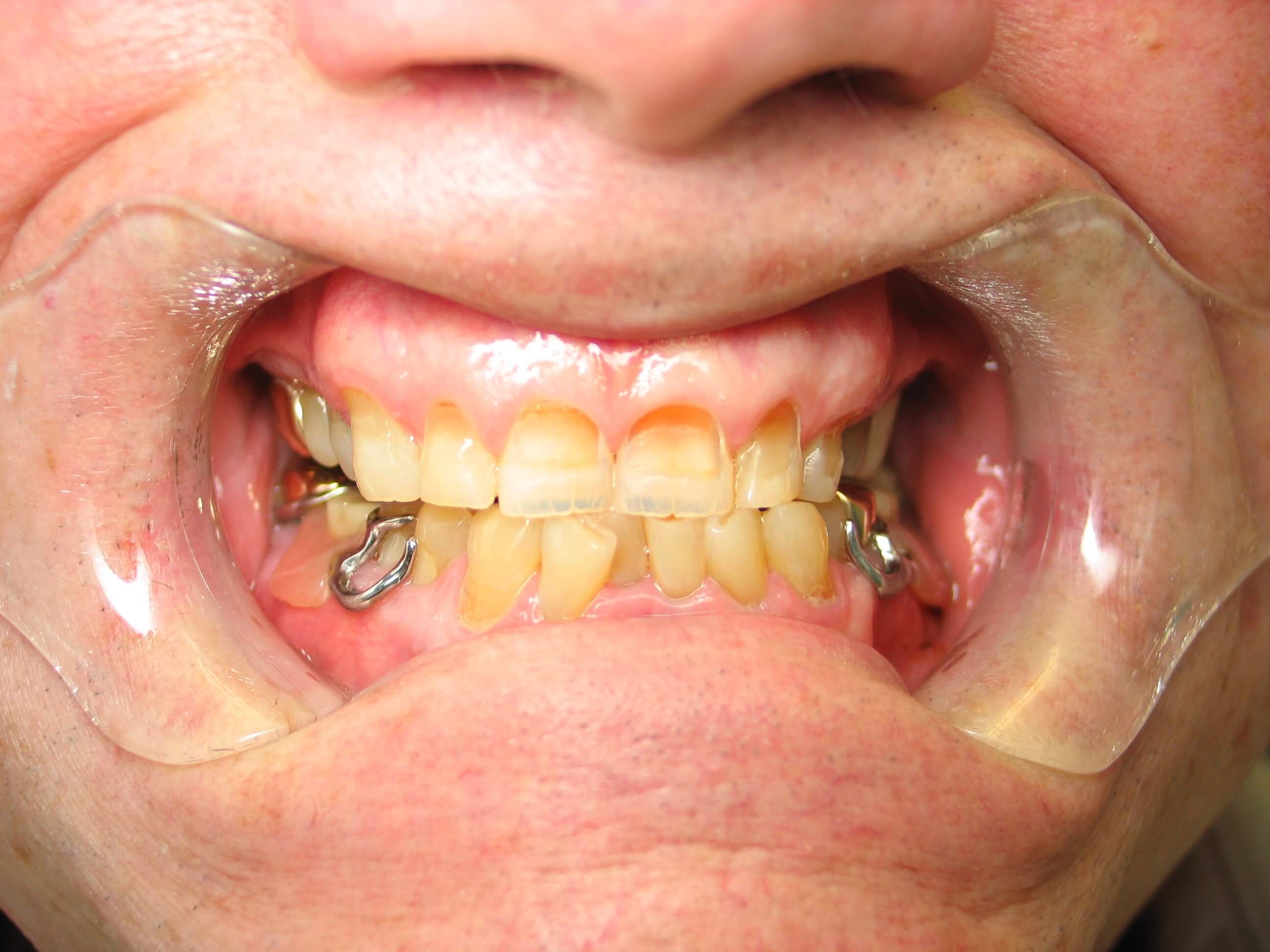 Dental Bonding - Wichita Falls Before