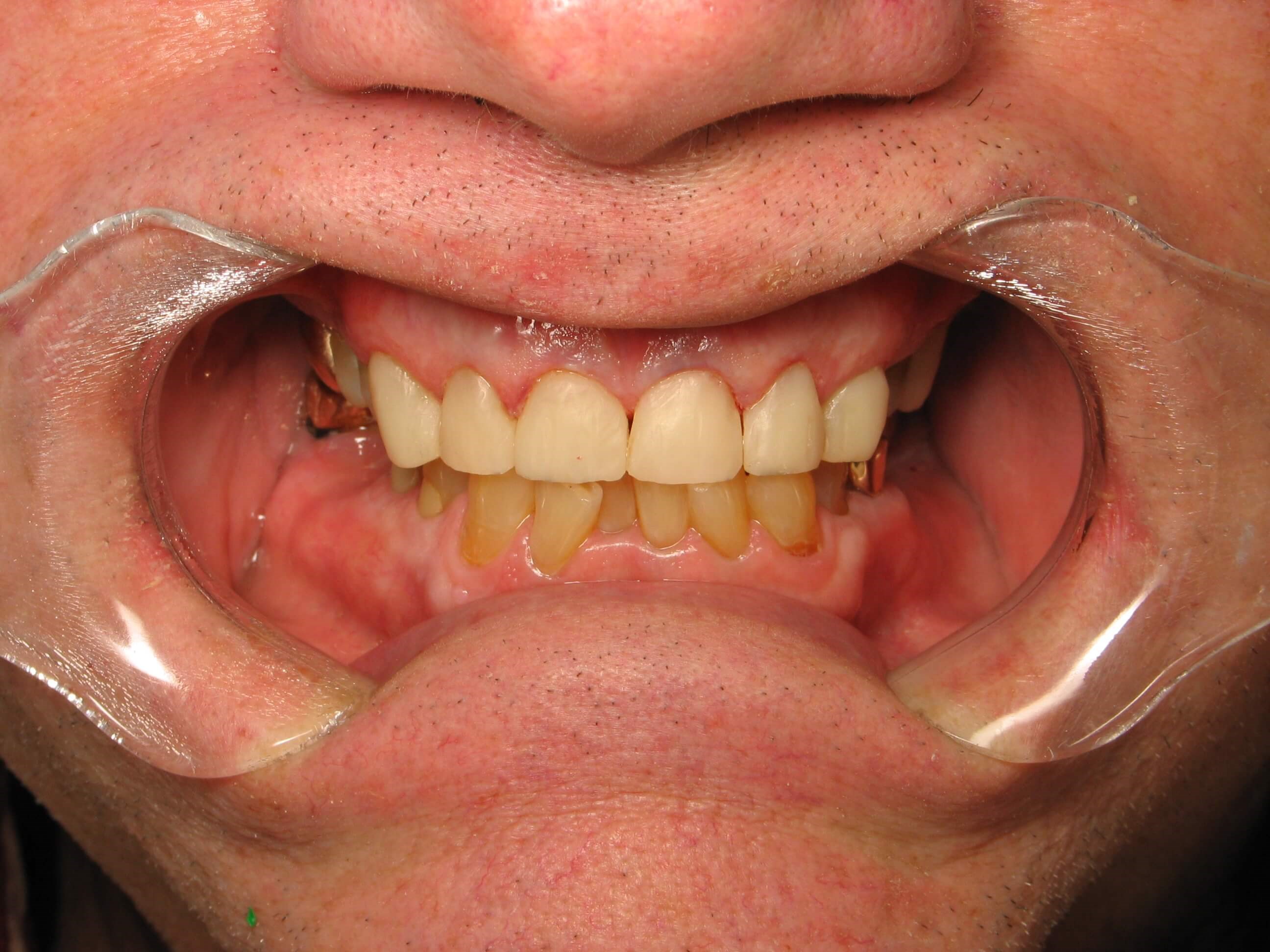 Dental Bonding - Wichita Falls After