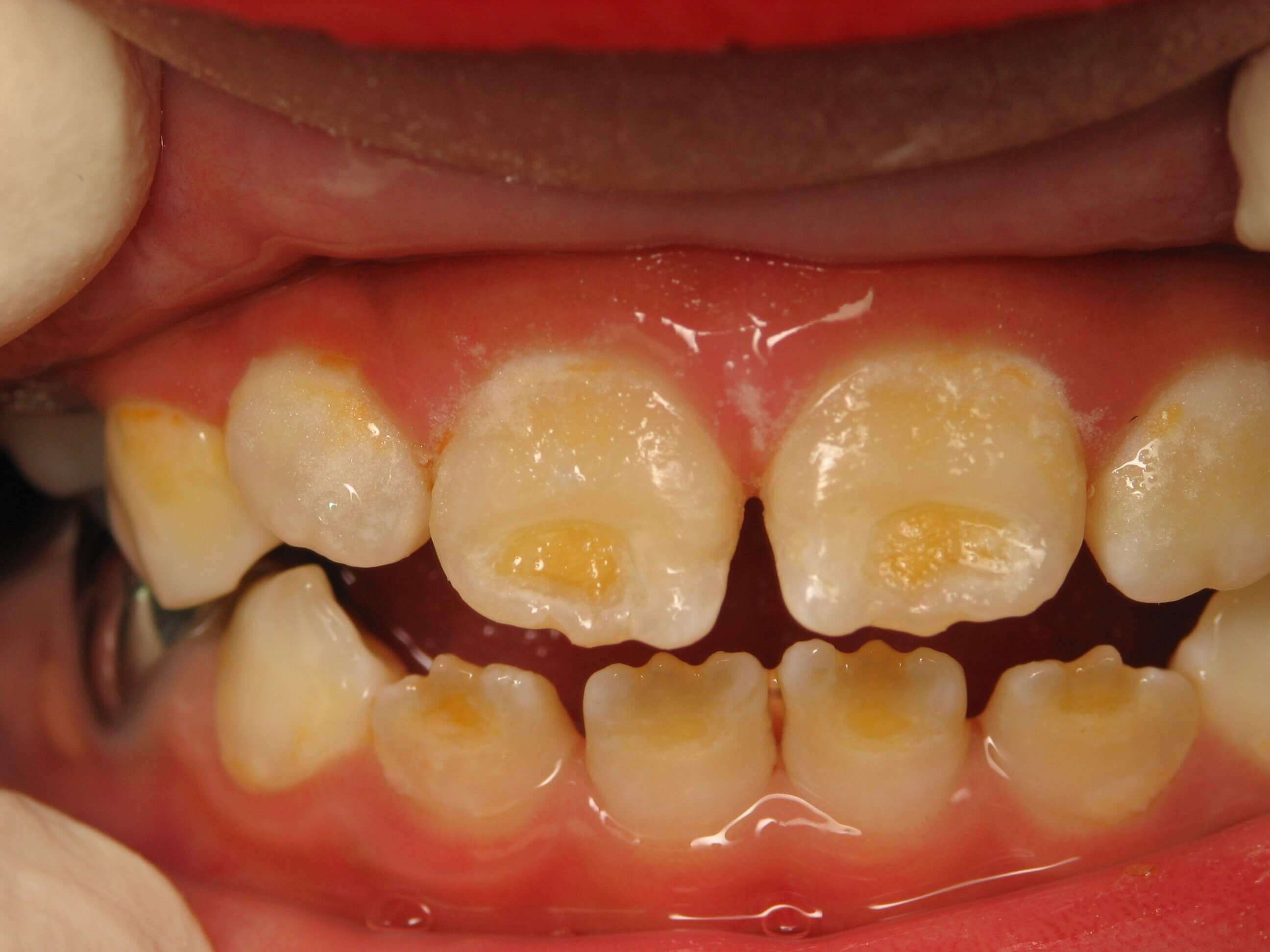 Enamel Hypoplasia Before