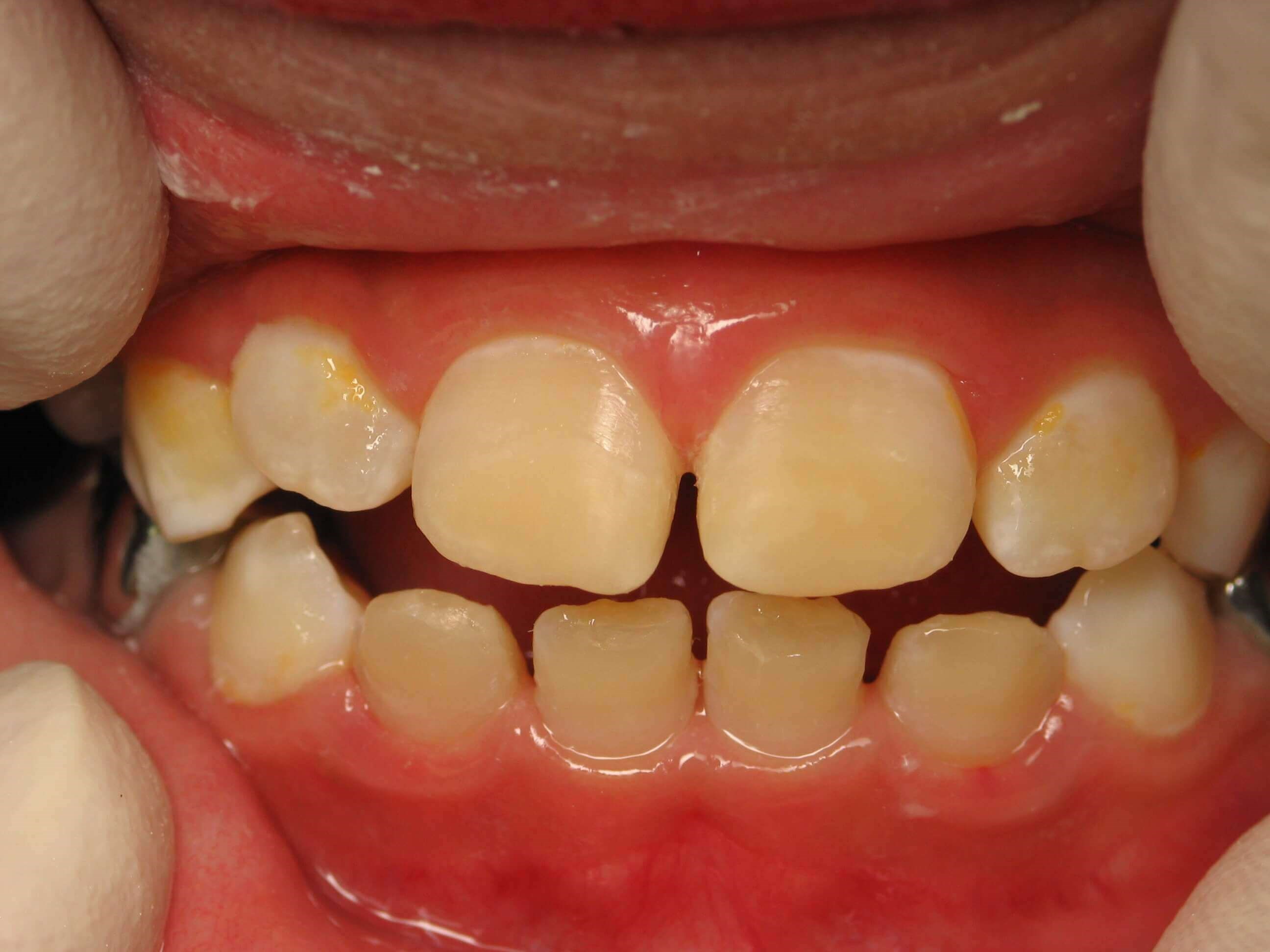 Enamel Hypoplasia After
