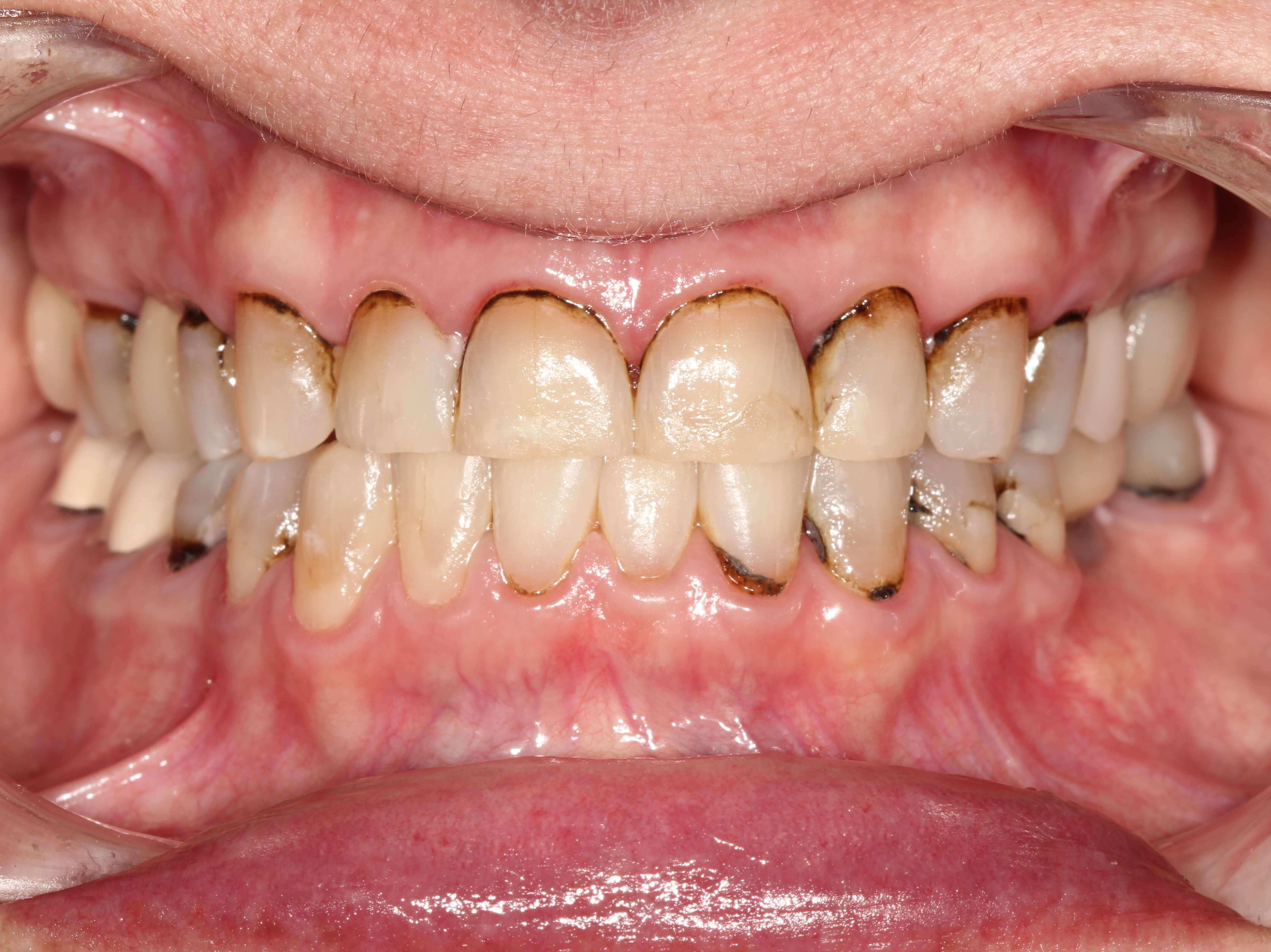 Smile Makeover Before & After Before