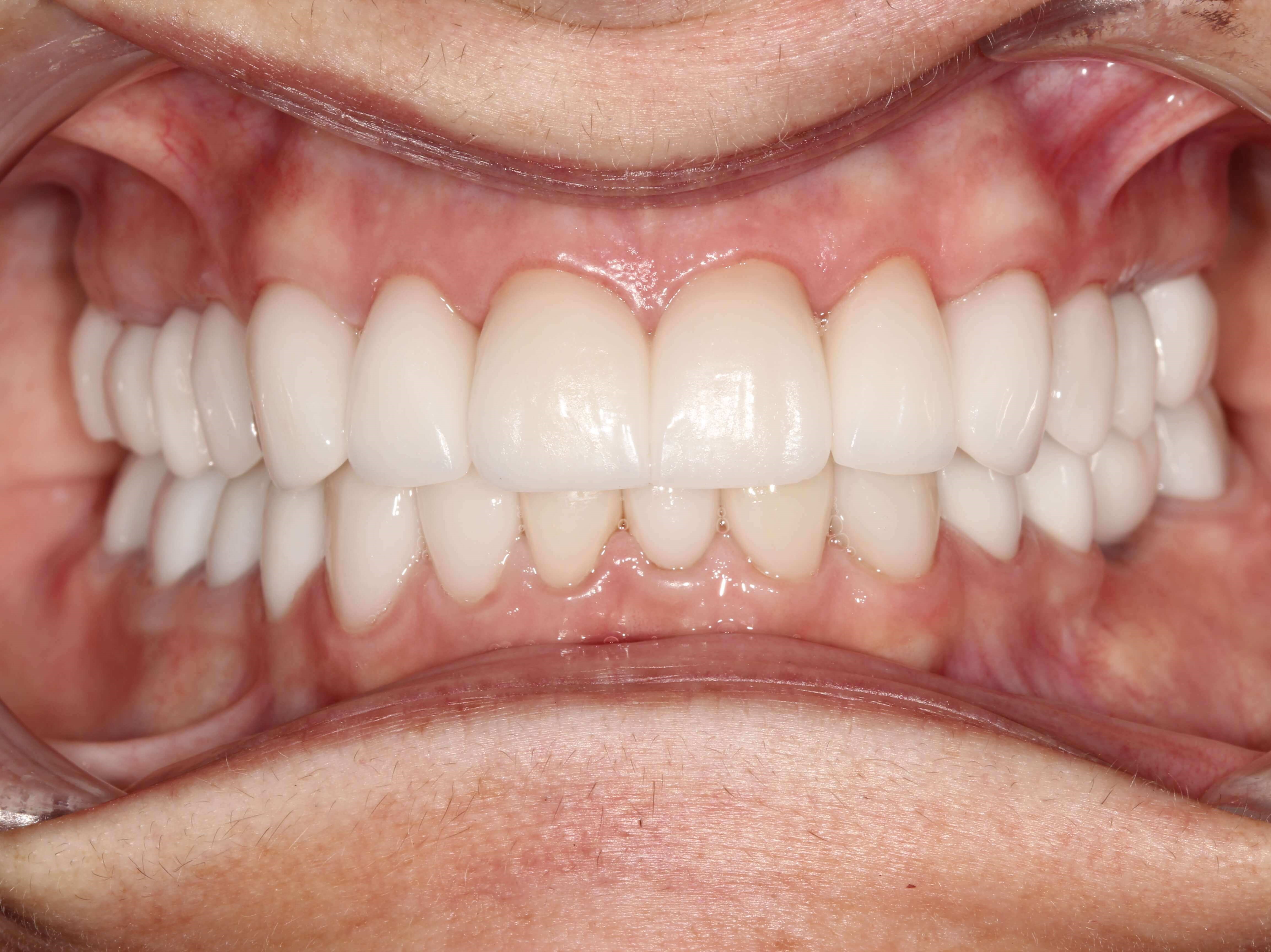 Smile Makeover Before & After After