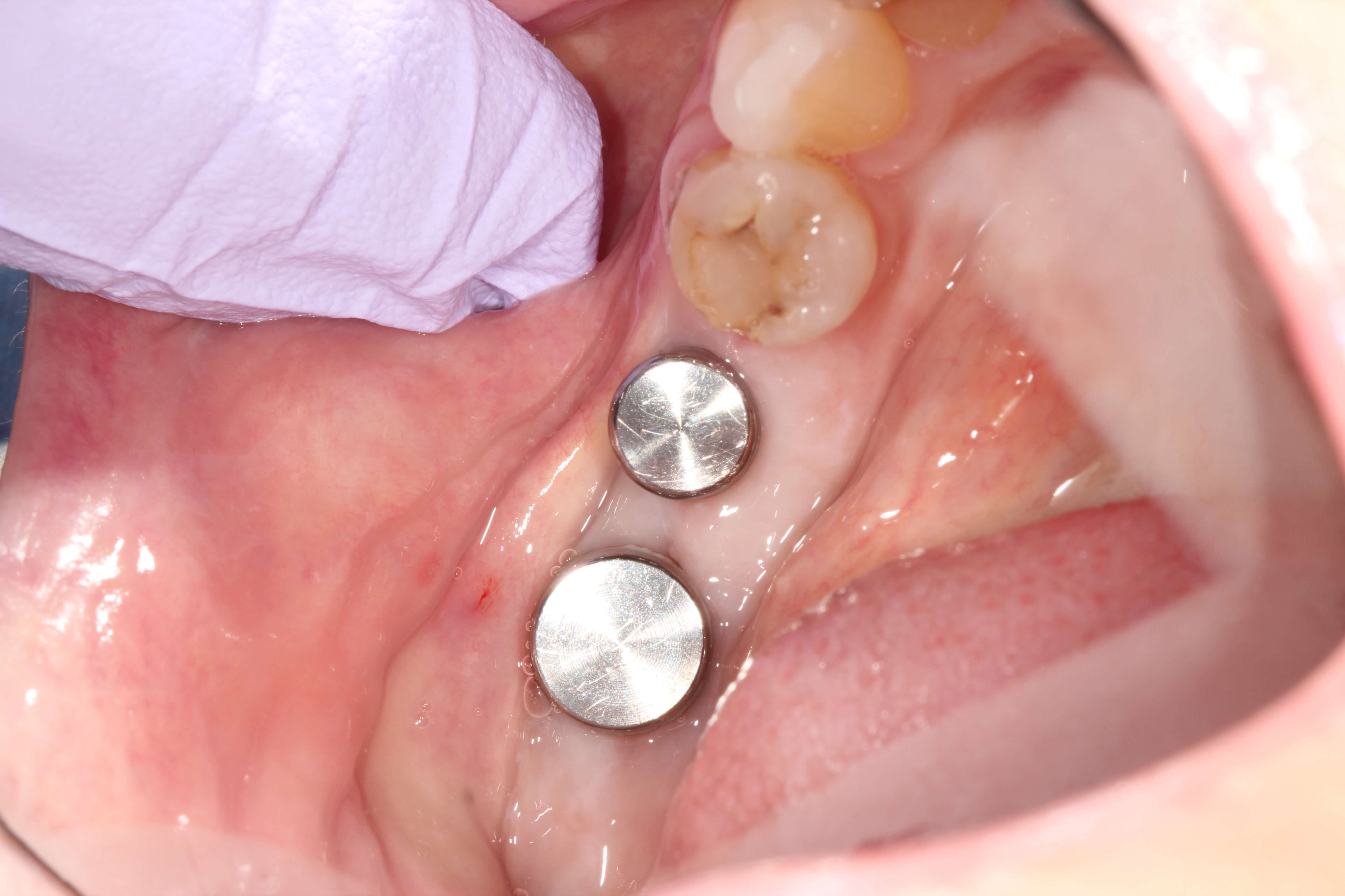 Needed Help Chewing Before