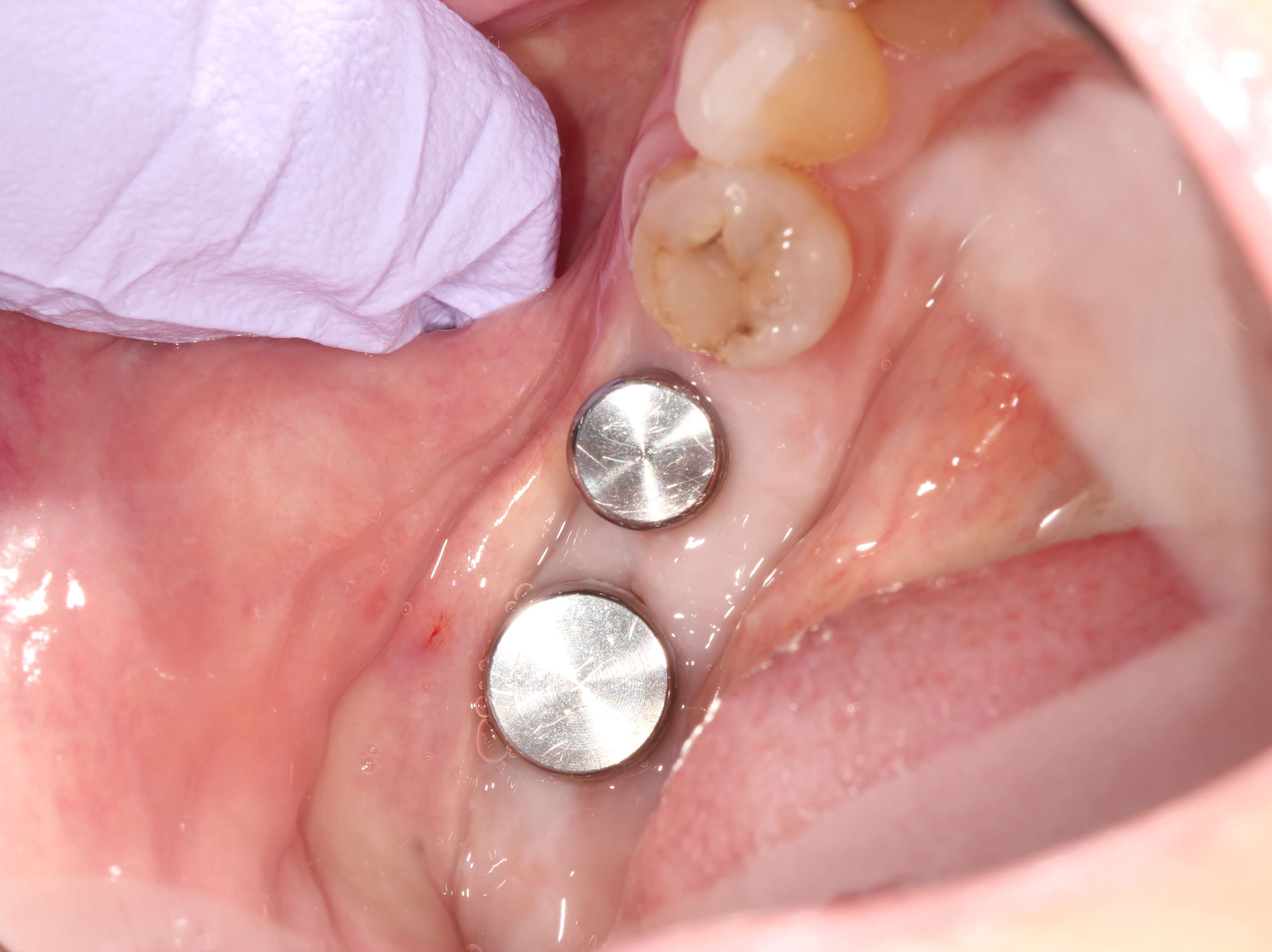 Needed Help Chewing Before