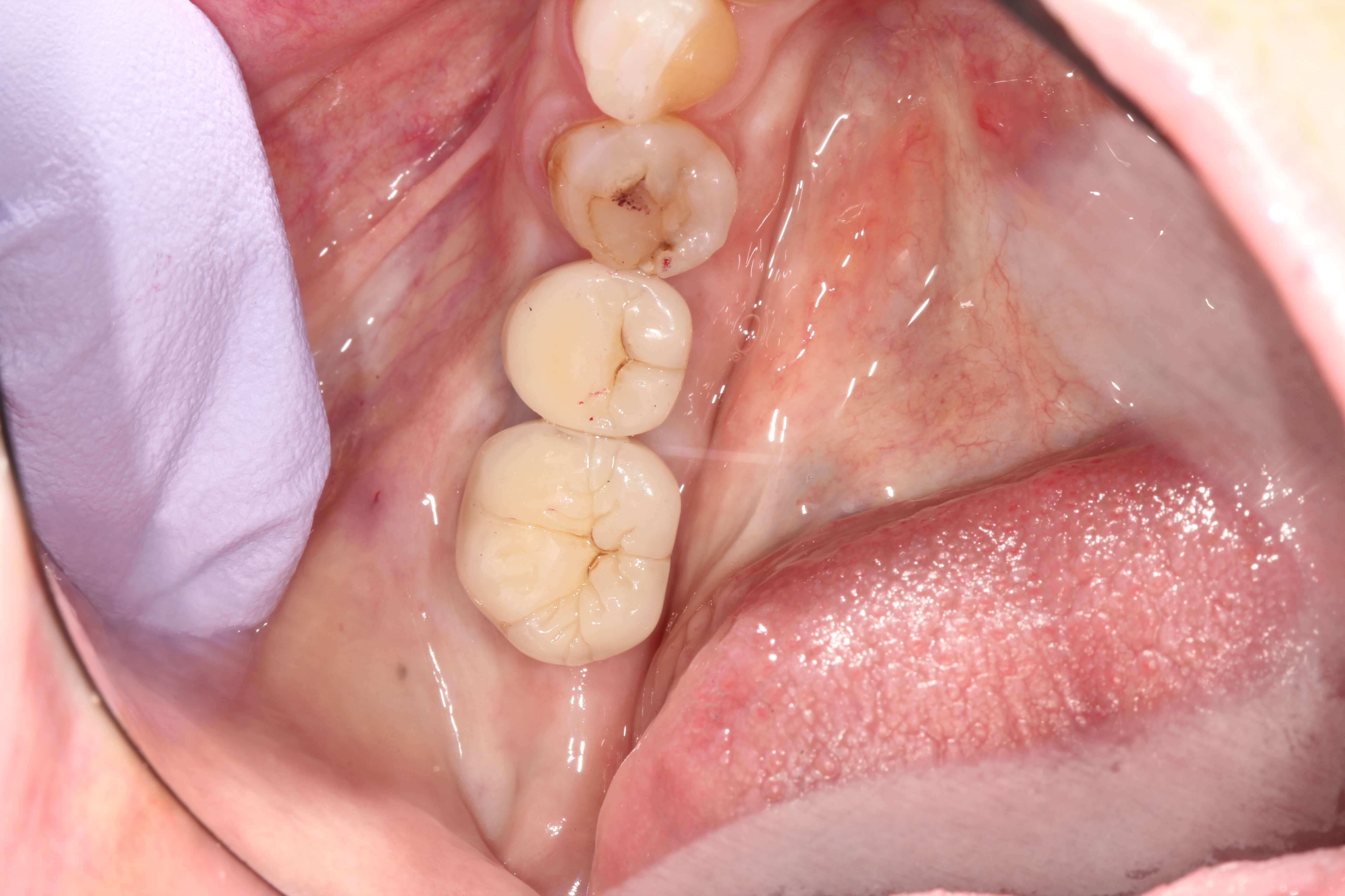 Needed Help Chewing After