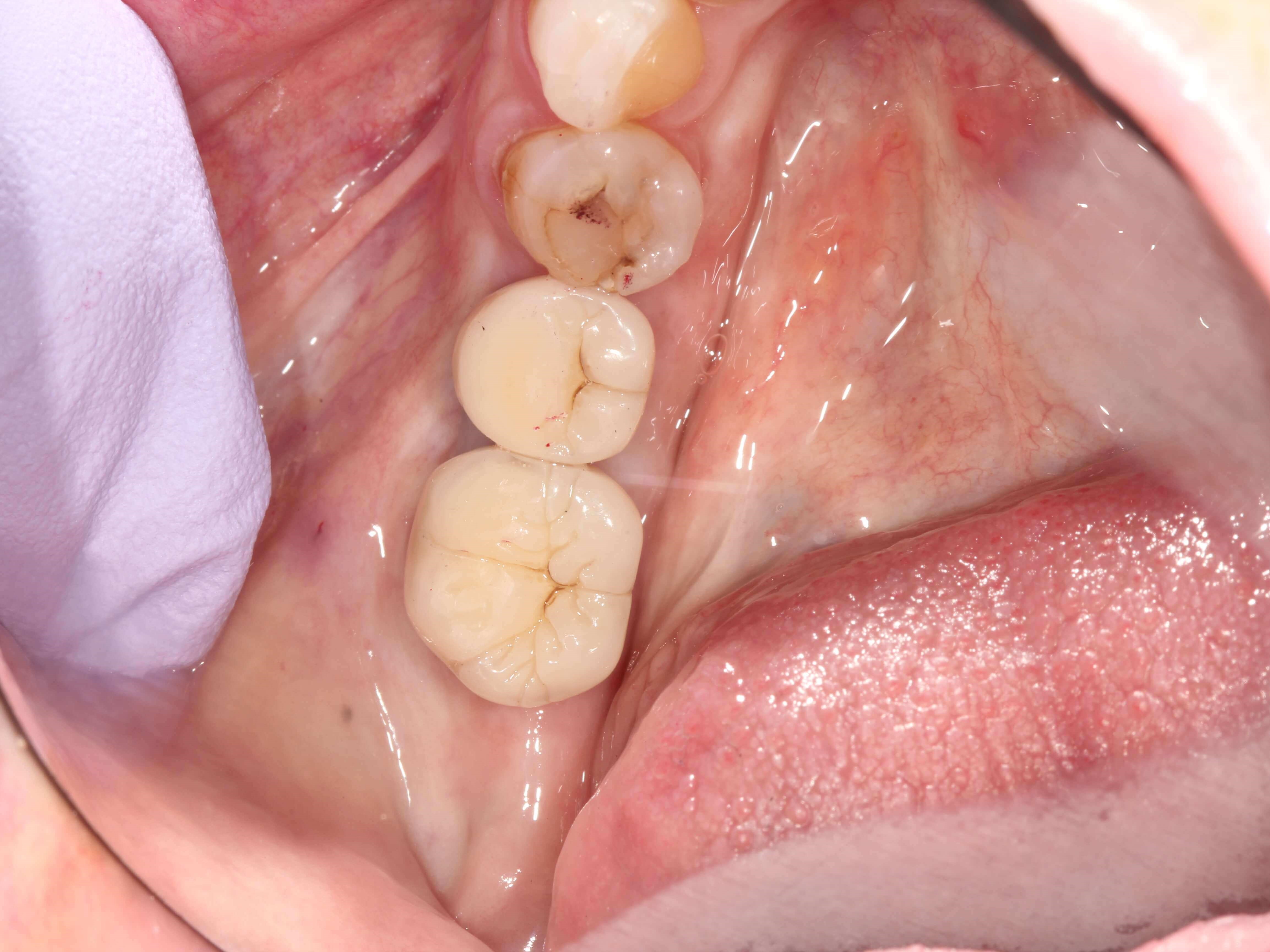 Needed Help Chewing After